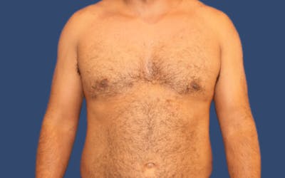 Gynecomastia Before & After Gallery - Patient 219502 - Image 2