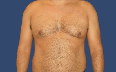 Gynecomastia Before & After Gallery - Patient 219502 - Image 1