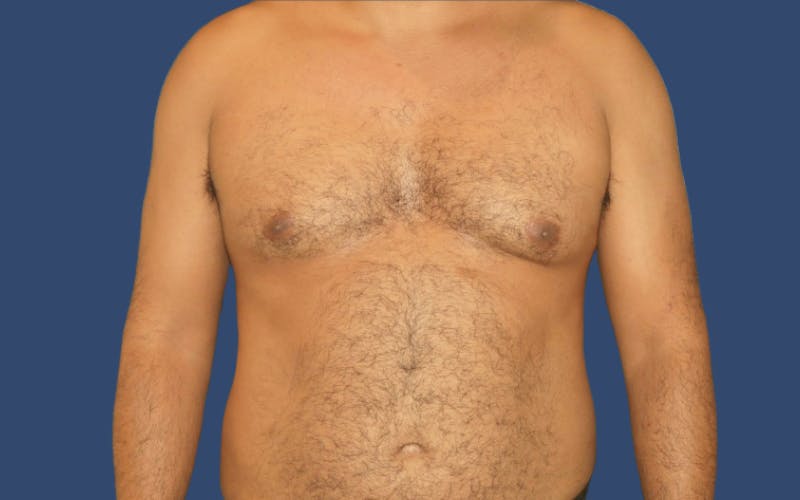 Gynecomastia Before & After Gallery - Patient 219502 - Image 1