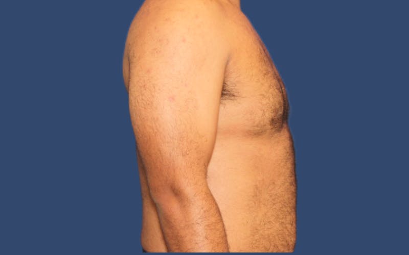Gynecomastia Before & After Gallery - Patient 219502 - Image 4