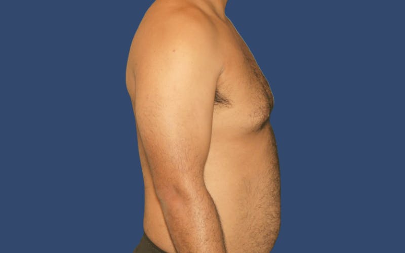 Gynecomastia Before & After Gallery - Patient 219502 - Image 3