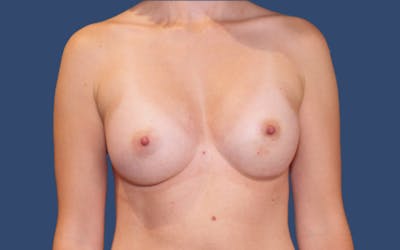 Breast Augmentation Before & After Gallery - Patient 841890 - Image 2