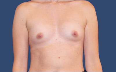 Breast Augmentation Before & After Gallery - Patient 841890 - Image 1