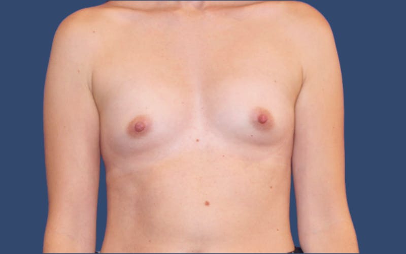 Breast Augmentation Before & After Gallery - Patient 841890 - Image 1