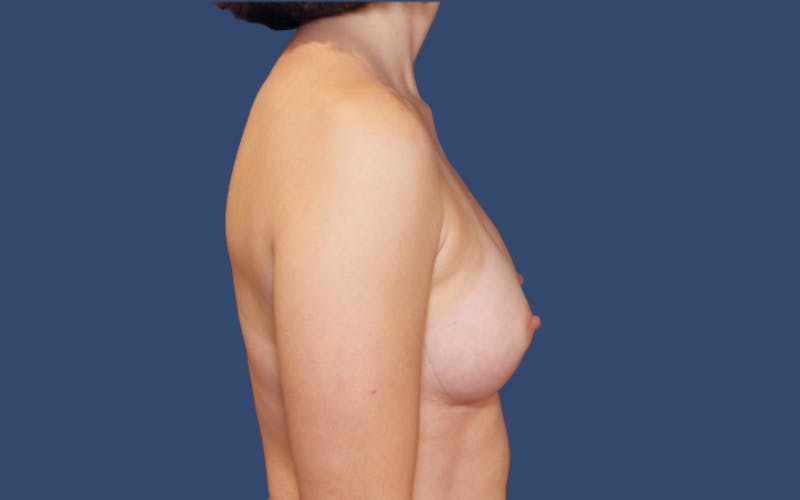 Breast Augmentation Before & After Gallery - Patient 841890 - Image 4
