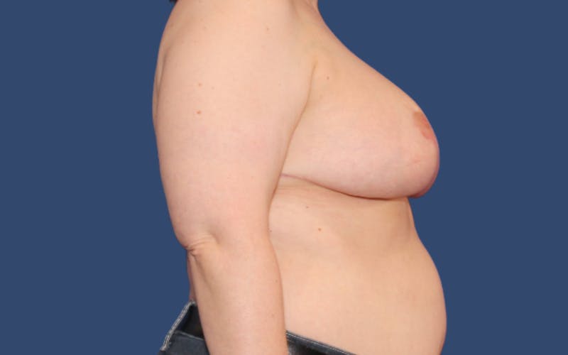 Breast Reduction Before & After Gallery - Patient 743132 - Image 4