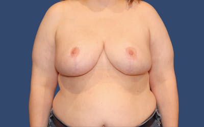 Breast Reduction Before & After Gallery - Patient 743132 - Image 2