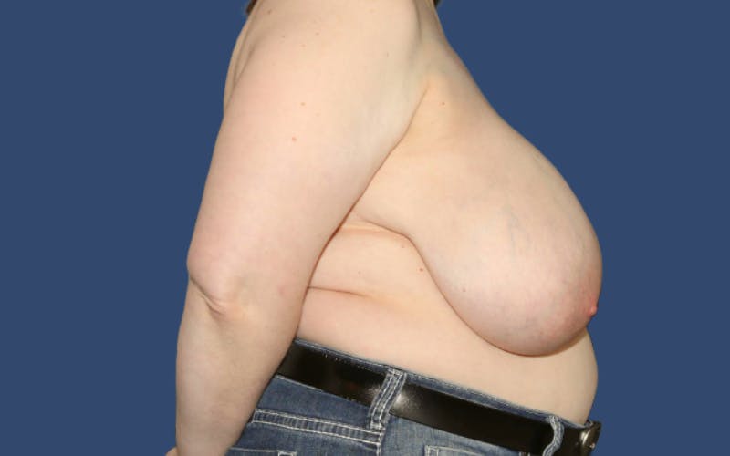 Breast Reduction Before & After Gallery - Patient 743132 - Image 3
