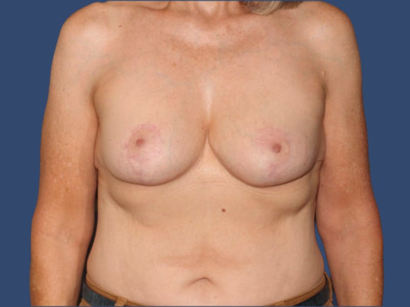 Breast Lift Before & After Gallery - Patient 205987 - Image 2