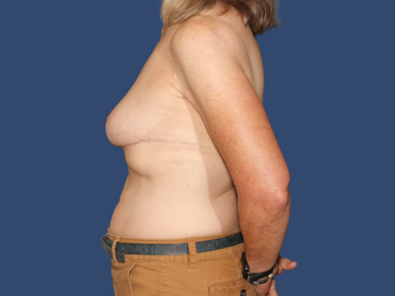 Breast Lift Before & After Gallery - Patient 205987 - Image 4