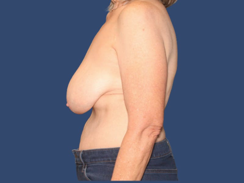 Breast Lift Before & After Gallery - Patient 205987 - Image 3