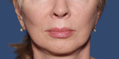 Dermal Fillers Before & After Gallery - Patient 423061 - Image 2