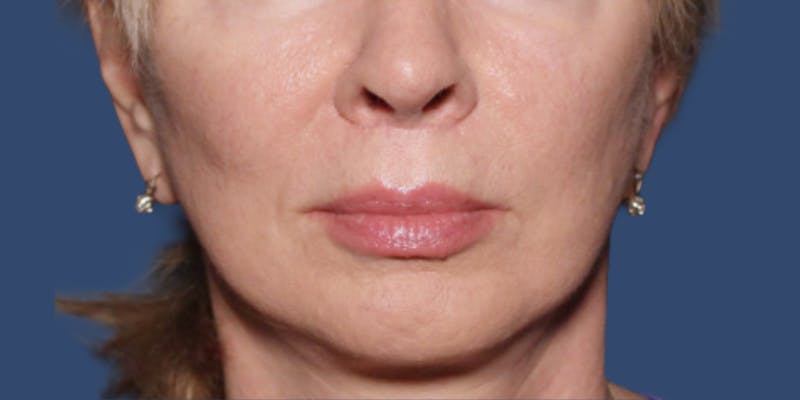 Dermal Fillers Before & After Gallery - Patient 423061 - Image 2