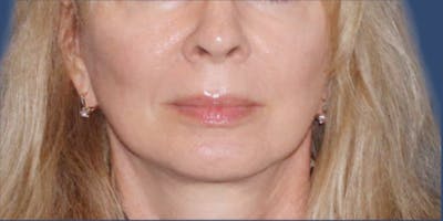 Dermal Fillers Before & After Gallery - Patient 423061 - Image 1
