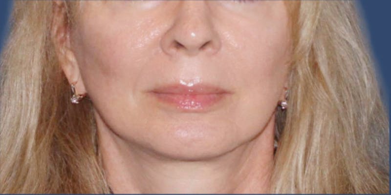Dermal Fillers Before & After Gallery - Patient 423061 - Image 1