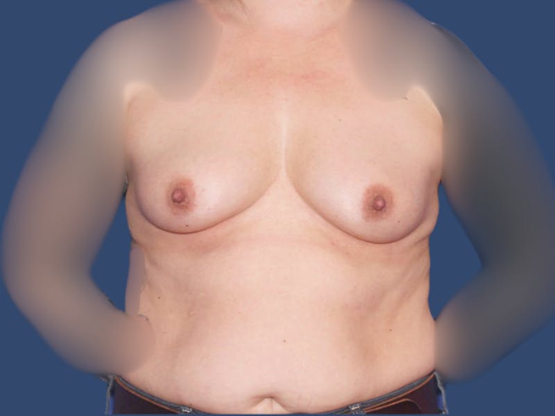 Breast Augmentation Before & After Gallery - Patient 348366 - Image 1