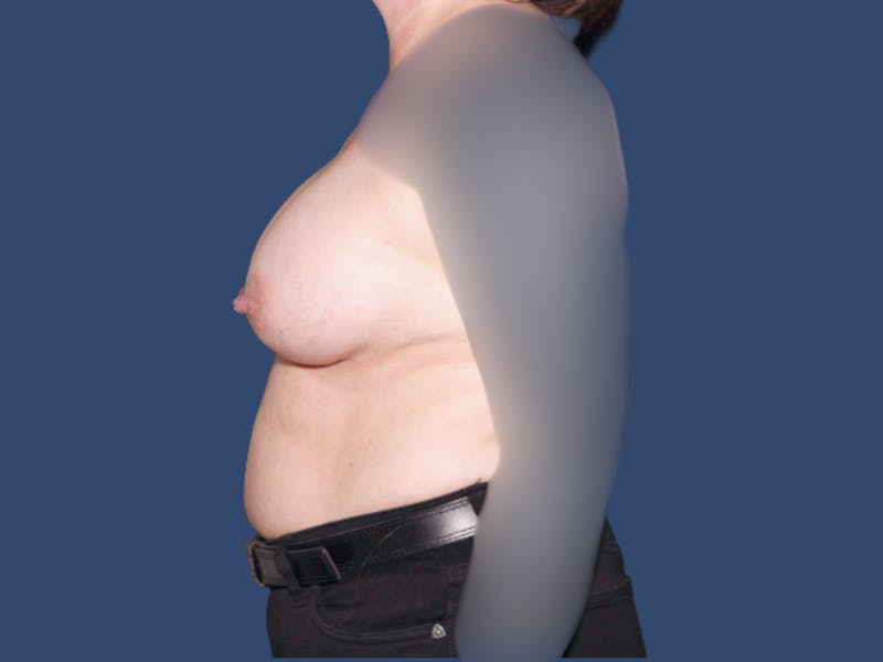 Breast Augmentation Before & After Gallery - Patient 348366 - Image 4