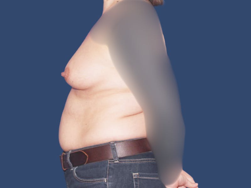 Breast Augmentation Before & After Gallery - Patient 348366 - Image 3