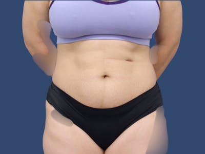 Tummy Tuck Before & After Gallery - Patient 114547 - Image 1