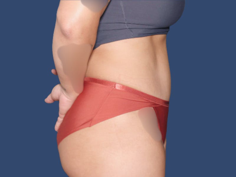 Tummy Tuck Before & After Gallery - Patient 114547 - Image 4