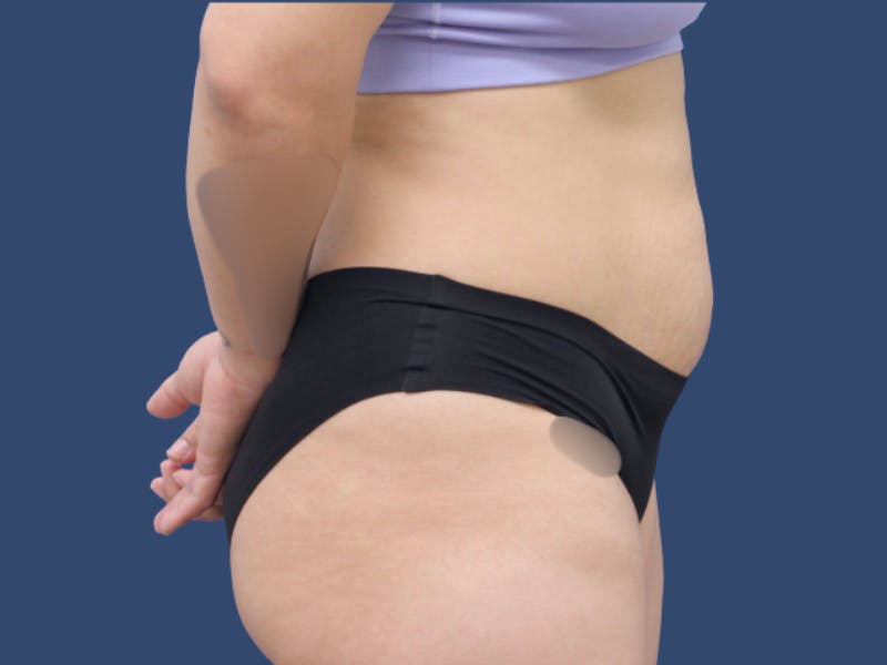 Tummy Tuck Before & After Gallery - Patient 114547 - Image 3