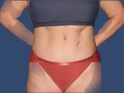 Tummy Tuck Before & After Gallery - Patient 114547 - Image 2