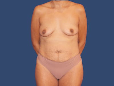 Tummy Tuck Before & After Gallery - Patient 292934 - Image 1