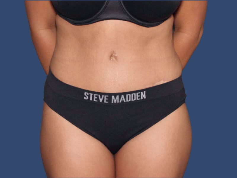 Tummy Tuck Before & After Gallery - Patient 407182 - Image 2