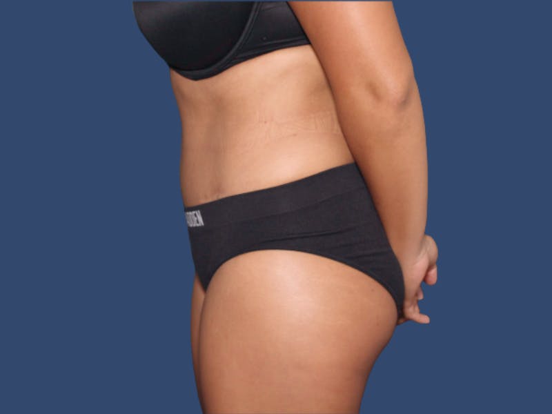 Tummy Tuck Before & After Gallery - Patient 407182 - Image 4