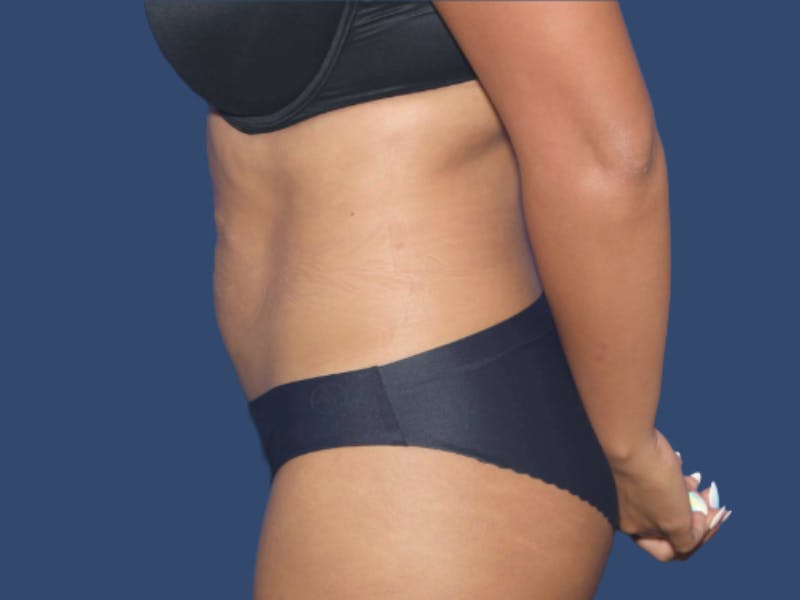 Tummy Tuck Before & After Gallery - Patient 407182 - Image 3