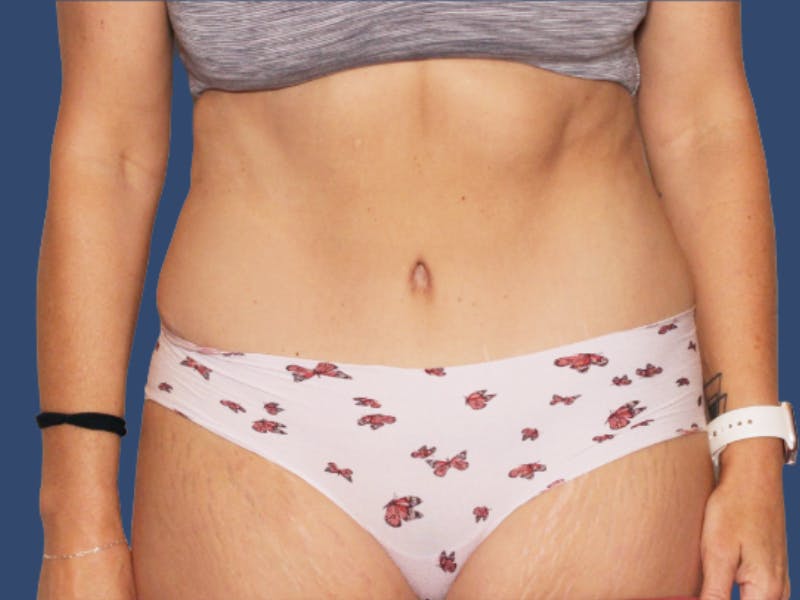 Tummy Tuck Before & After Gallery - Patient 818682 - Image 2