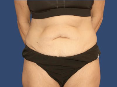 Tummy Tuck Before & After Gallery - Patient 818682 - Image 1