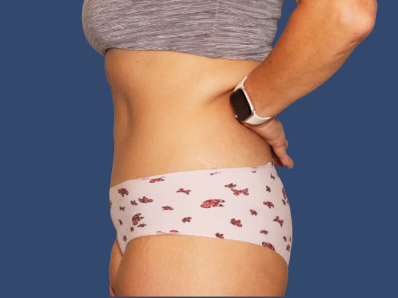 Tummy Tuck Before & After Gallery - Patient 818682 - Image 4