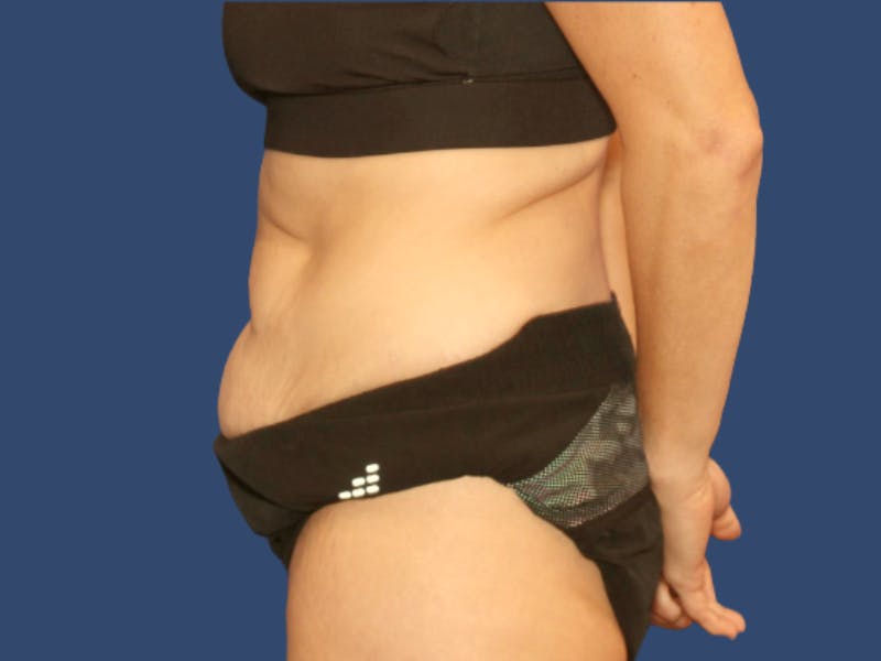 Tummy Tuck Before & After Gallery - Patient 818682 - Image 3