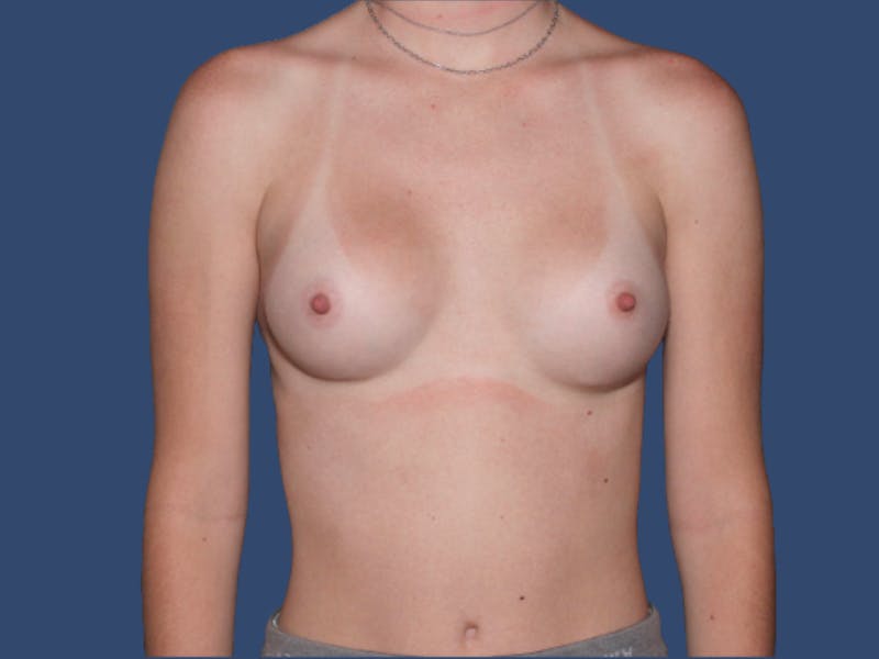 Breast Augmentation Before & After Gallery - Patient 321301 - Image 2