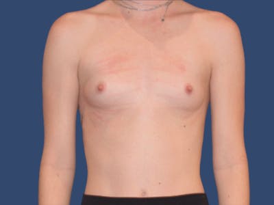 Breast Augmentation Before & After Gallery - Patient 321301 - Image 1
