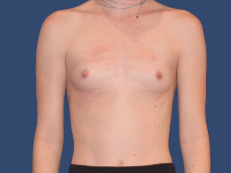 Breast Augmentation Before & After Gallery - Patient 321301 - Image 1