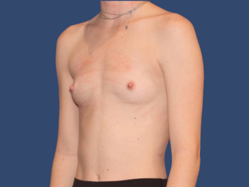 Breast Augmentation Before & After Gallery - Patient 321301 - Image 3
