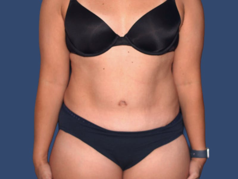 Tummy Tuck Before & After Gallery - Patient 495365 - Image 2