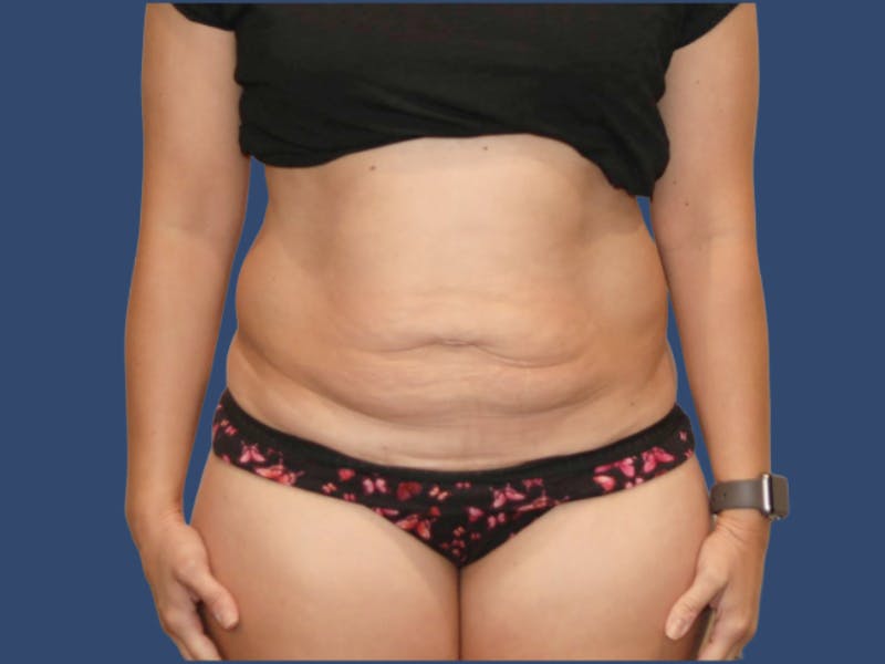 Tummy Tuck Before & After Gallery - Patient 495365 - Image 1
