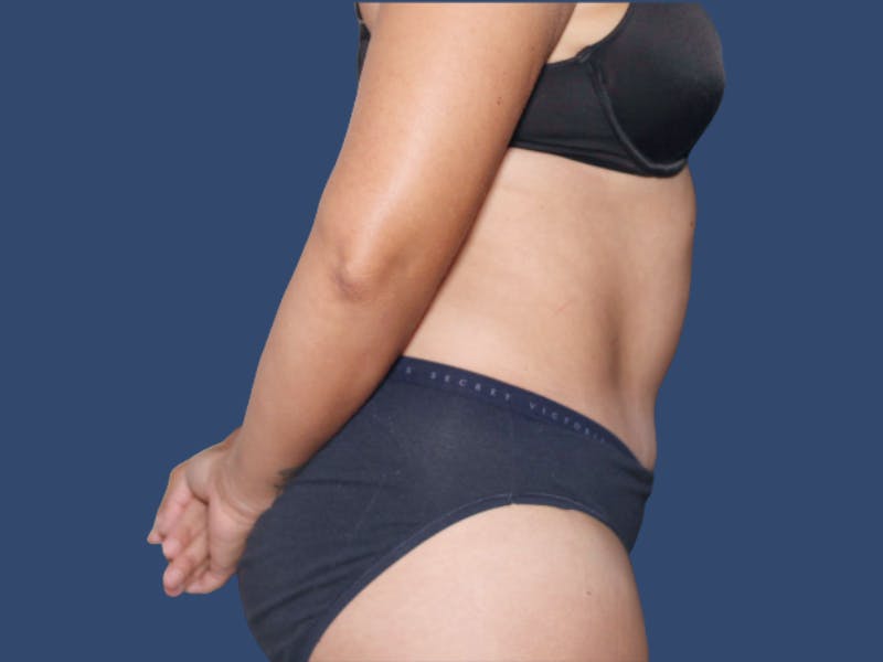 Tummy Tuck Before & After Gallery - Patient 495365 - Image 4