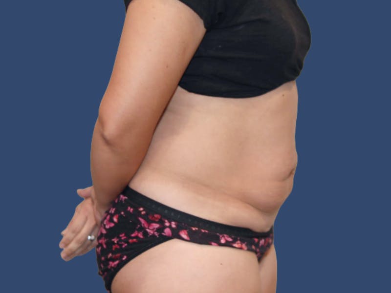 Tummy Tuck Before & After Gallery - Patient 495365 - Image 3
