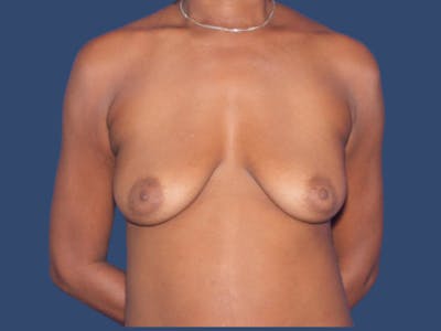 Breast Lift with Augmentation Before & After Gallery - Patient 170732 - Image 1