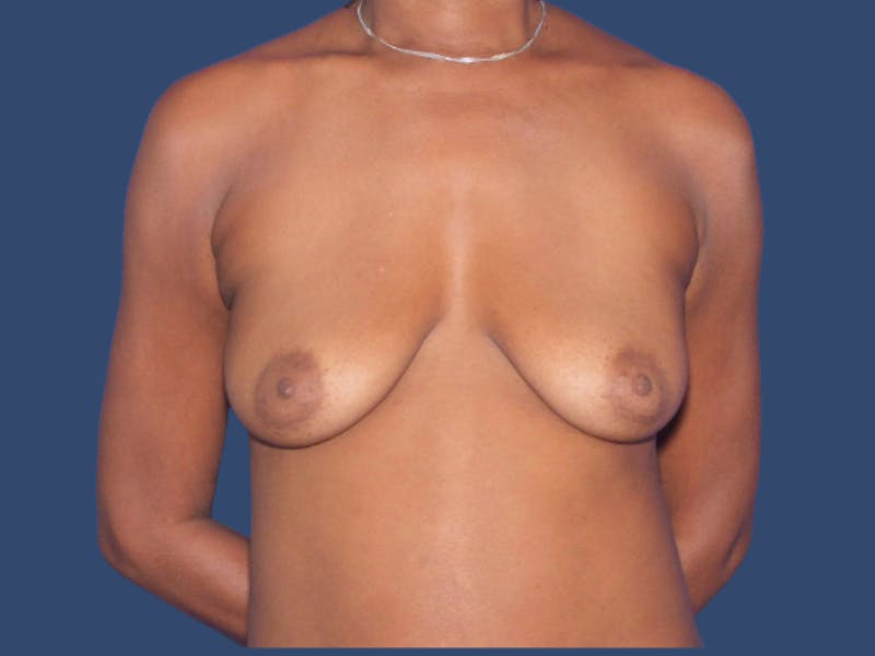 Breast Augmentation Before & After Gallery - Patient 244987 - Image 1