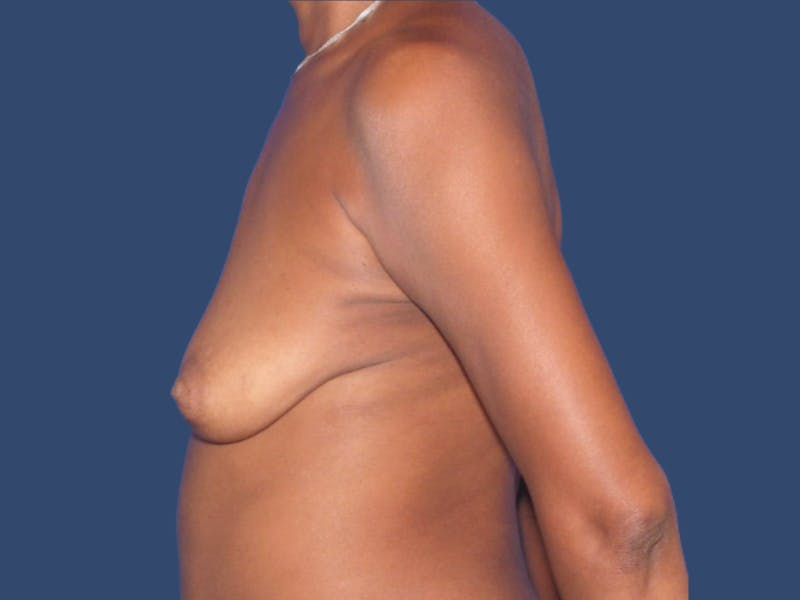 Breast Augmentation Before & After Gallery - Patient 244987 - Image 3