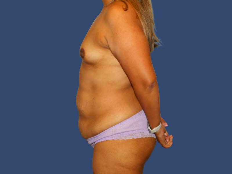 Tummy Tuck Before & After Gallery - Patient 604490 - Image 3