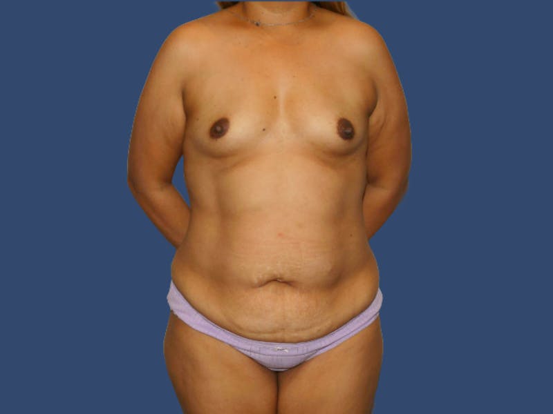 Tummy Tuck Before & After Gallery - Patient 604490 - Image 1