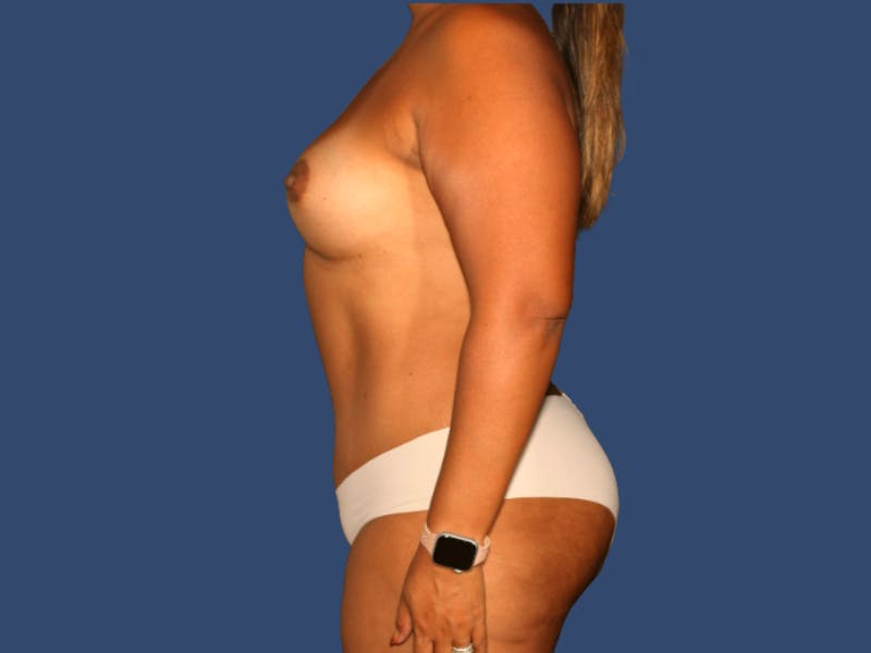 Tummy Tuck Before & After Gallery - Patient 604490 - Image 4