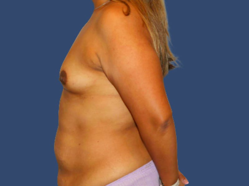 Breast Augmentation Before & After Gallery - Patient 331055 - Image 3