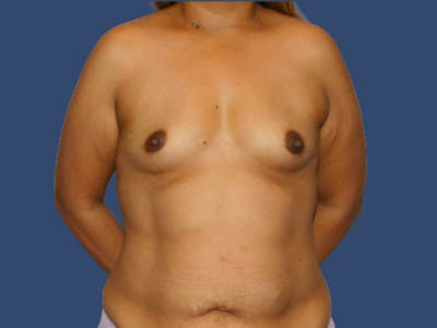 Breast Augmentation Before & After Gallery - Patient 331055 - Image 1